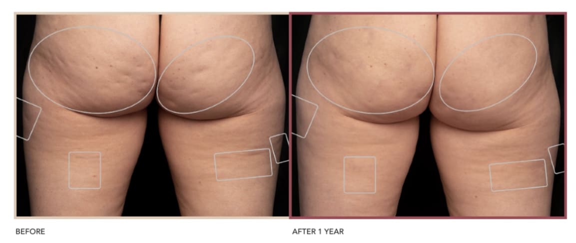 Before and After image of Avéli Cellulite Treatment North Hollywood CA