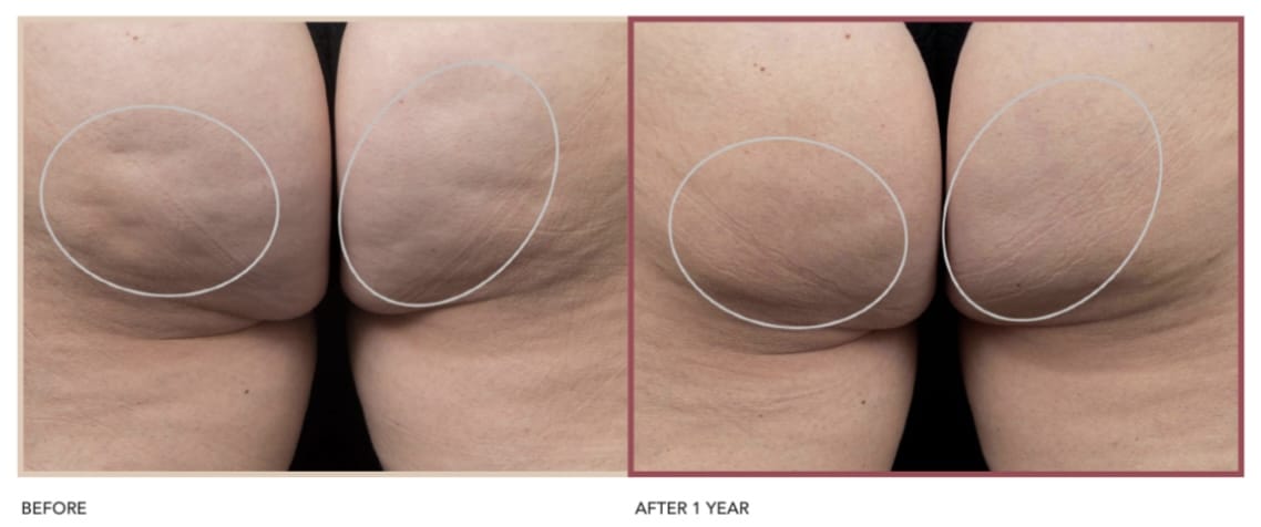 Before and After image of Avéli Cellulite Treatment Studio City CA