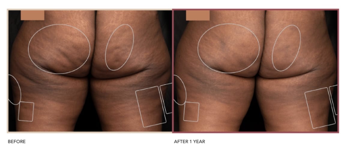Before and After image of Cellulite Reduction Studio City CA