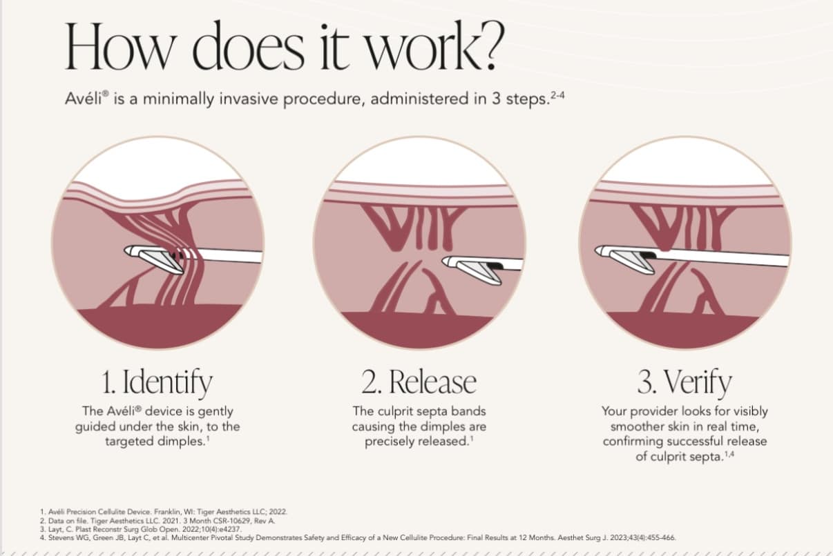 Avéli Cellulite Treatment North Hollywood CA