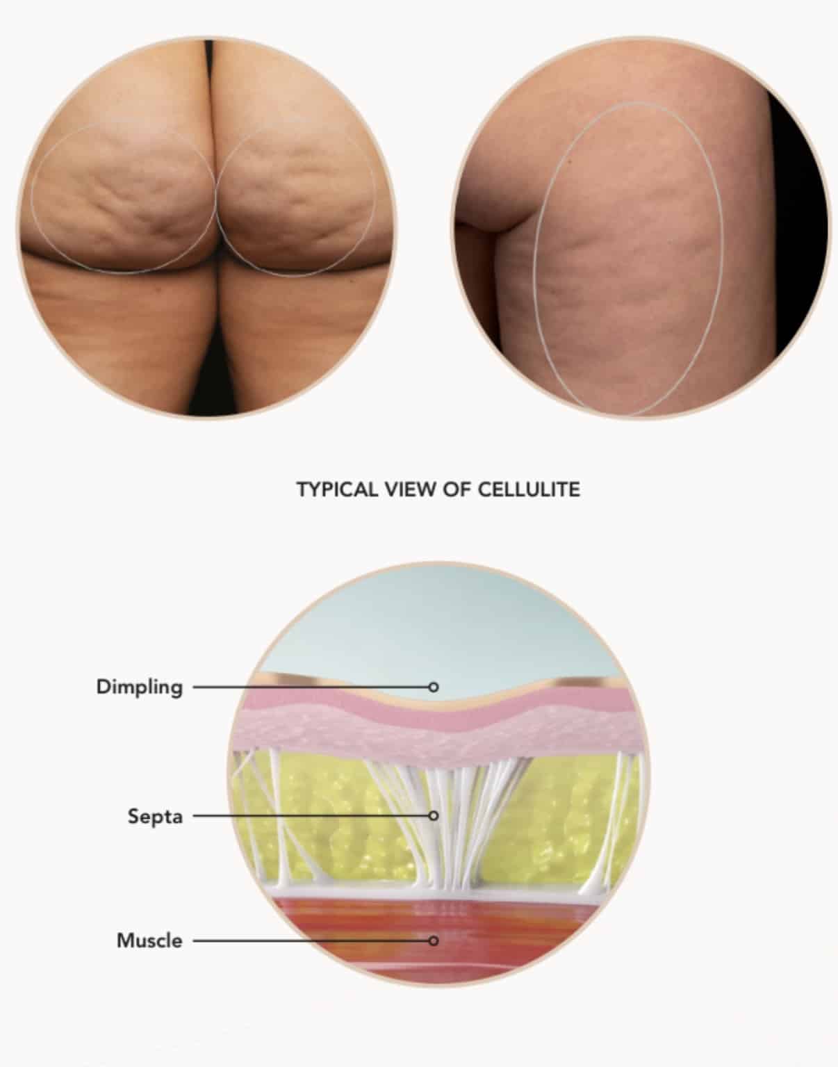 Cellulite Reduction Studio City CA